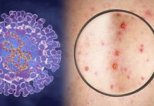 Kërçovari u testua për lijën e majmunit, dalin rezultatet