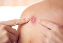 Nuk ka asnjë rast të konfirmuar me “linë e majmunëve” në RMV