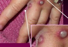 Pacienti nga Kërçova i dyshuar se ka lije të majmunit pranoi të testohet, rezultati publikohet sonte