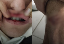 Tetovë, policia e bën për spital 22-vjeçarin!