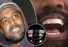 Kanye West heq të gjithë dhëmbët e tij dhe i zëvendëson me proteza titani që kushtojnë 783 mijë euro