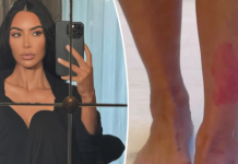 Kim Kardashian tregon realitetin e dhimbshëm të ‘shpërthimit’ të psoriazës: Nuk e di se çfarë po ndodh
