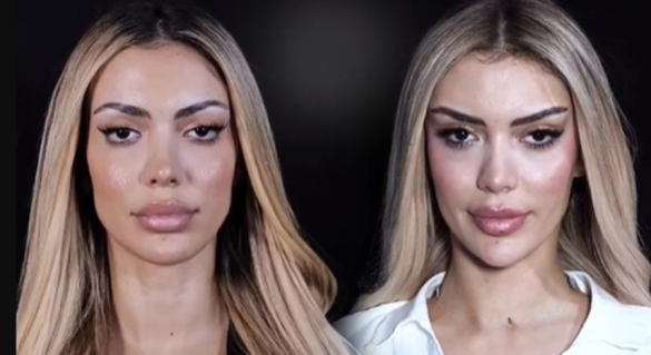 I publikuan fotot e ndërhyrjeve estetike kur ishte në Big Brother, Brikena: Tradhti!